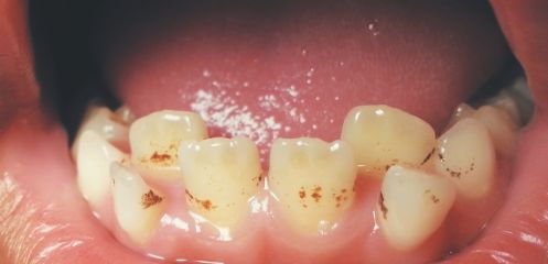 Loose or shifting teeth
